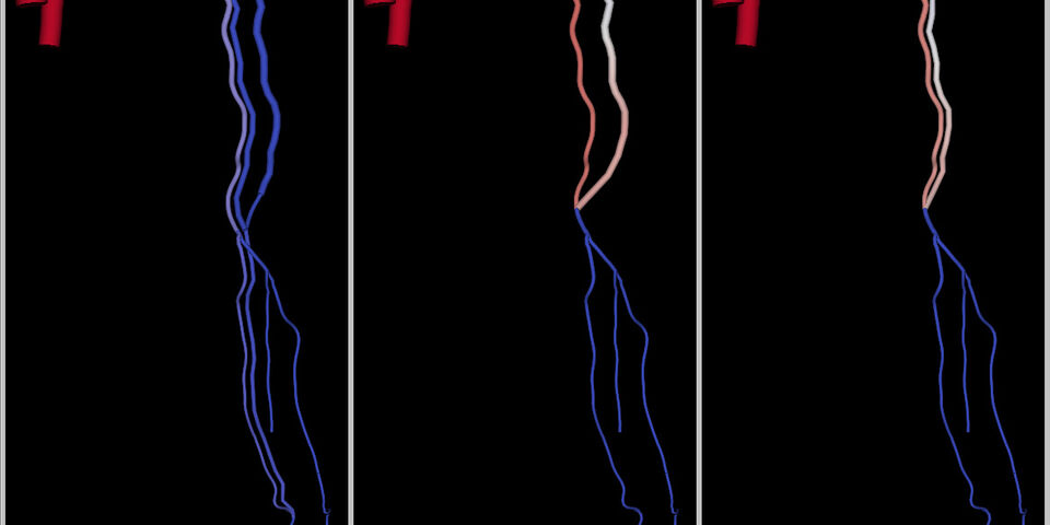 Voorspellingen van de gevolgen van de aanleg van een dialyse-fistel op drie verschillende plaatsen: onderarm (RC-AVF), bovenarm (BB-AVF) en nogmaals in de bovenarm (BC-AVF). Rood geeft veel bloedstroming aan, blauw weinig. Het model voorspelt dat er heel veel bloedstroming optreedt als de fistel in de bovenarm wordt gemaakt, terwijl er in de onderarmsonfiguratie voldoende flow zal zijn. Dus de onderarmfistel heeft de voorkeur.